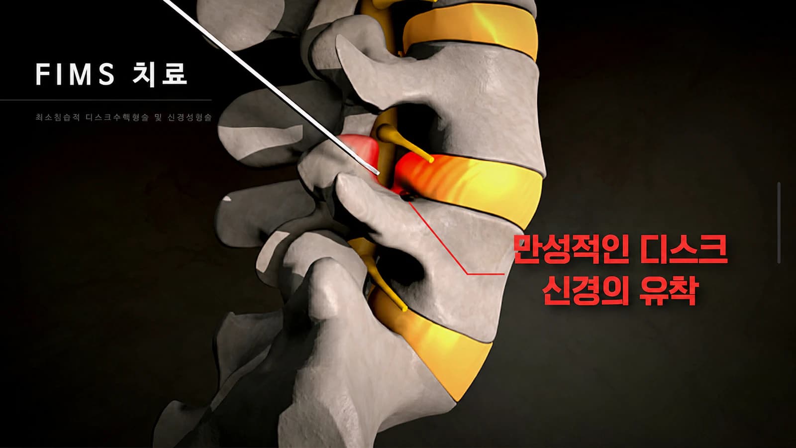 디스크와 신경 주변 상태를 설명하는 FIMS 이미지