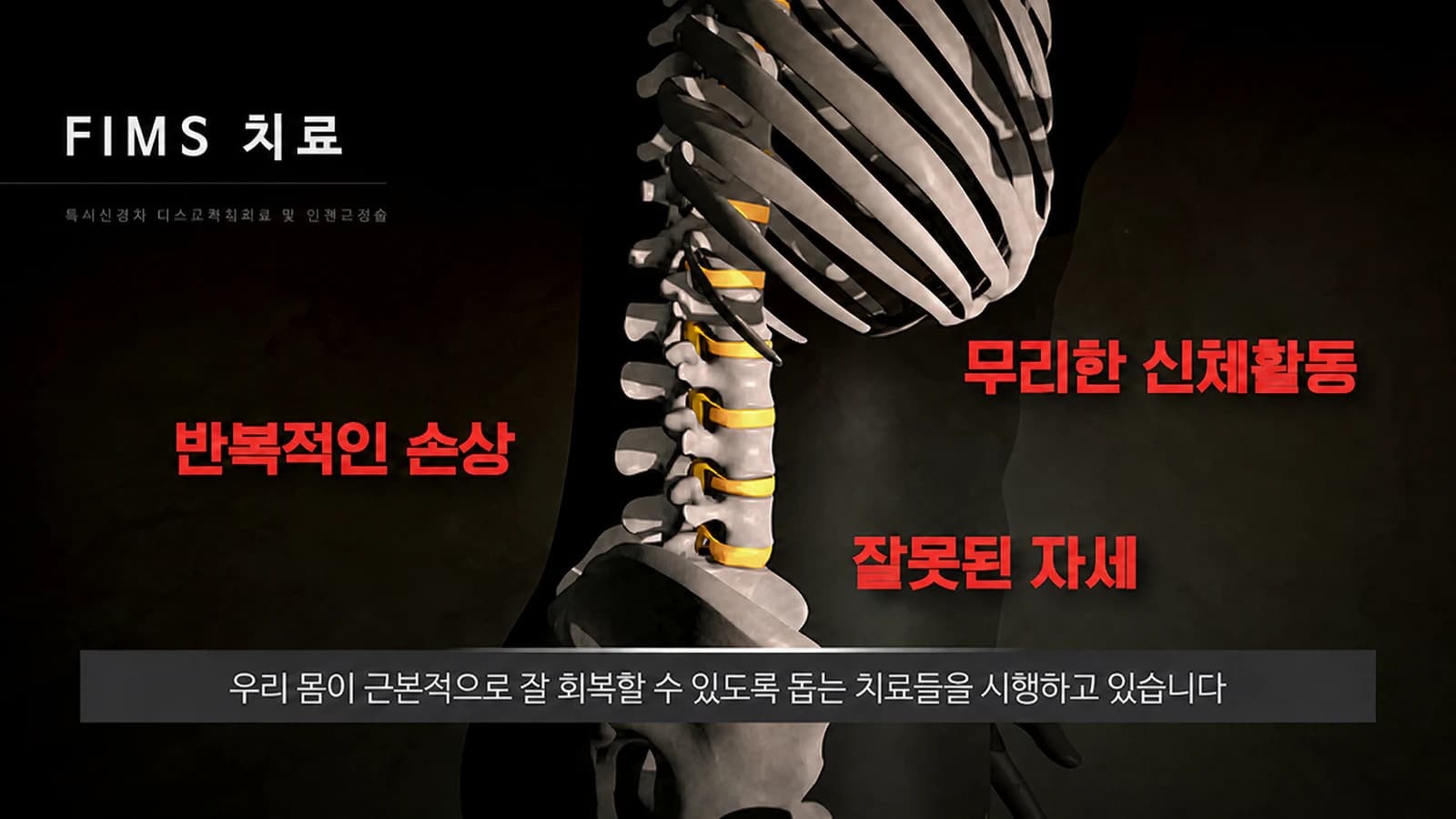 통증 발생 원인을 설명하는 FIMS 이미지