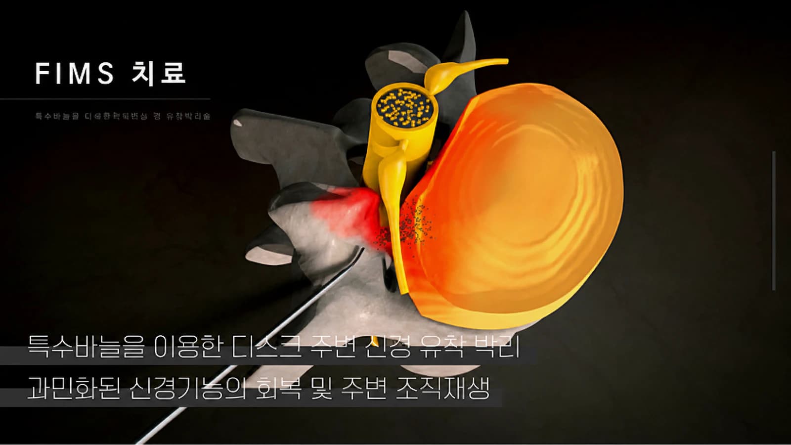 근육과 주변 조직 상태를 설명하는 FIMS 이미지